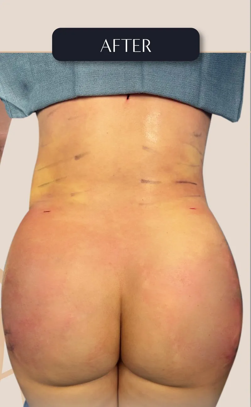 Brazilian Butt Lift result