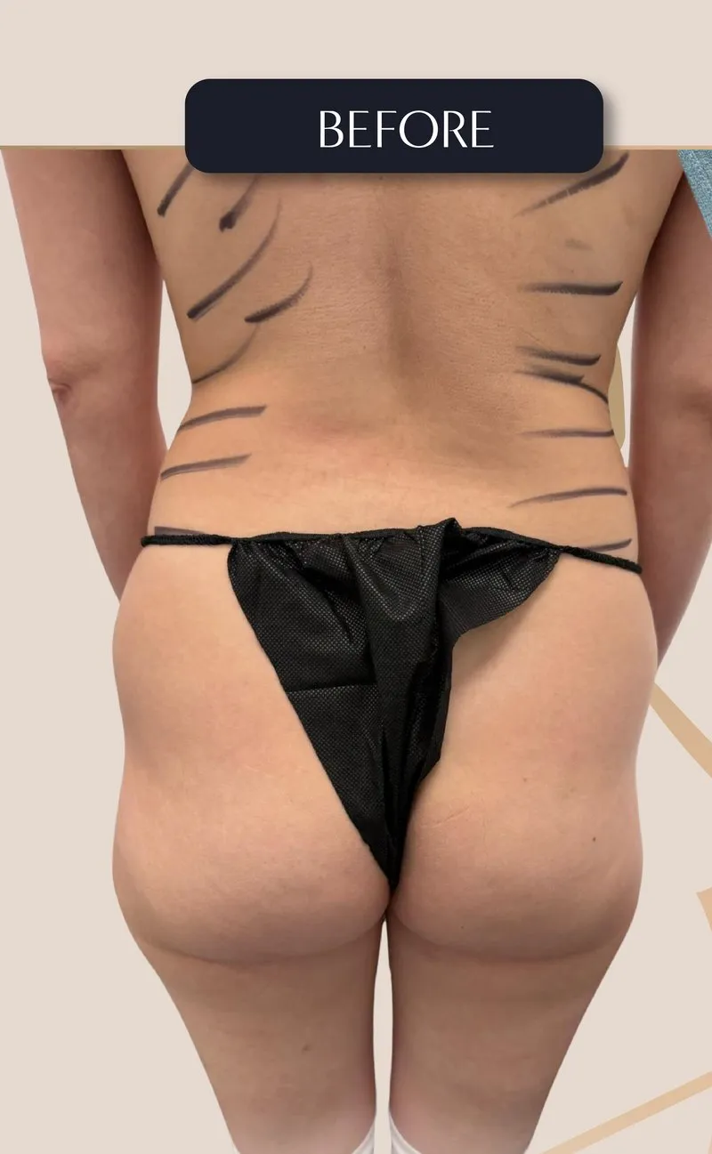Before - Brazilian Butt Lift (BBL) - Natural BBL with waist contouring