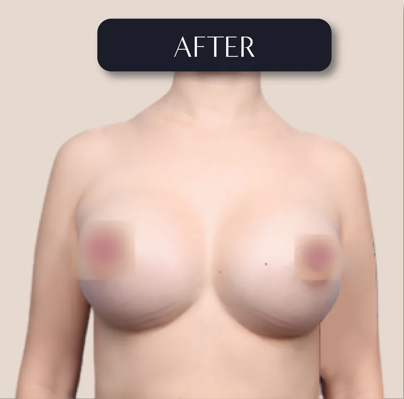 Breast Augmentation result