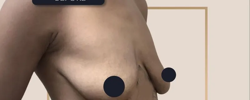 Before - Breast Augmentation - Natural enhancement with silicone implants