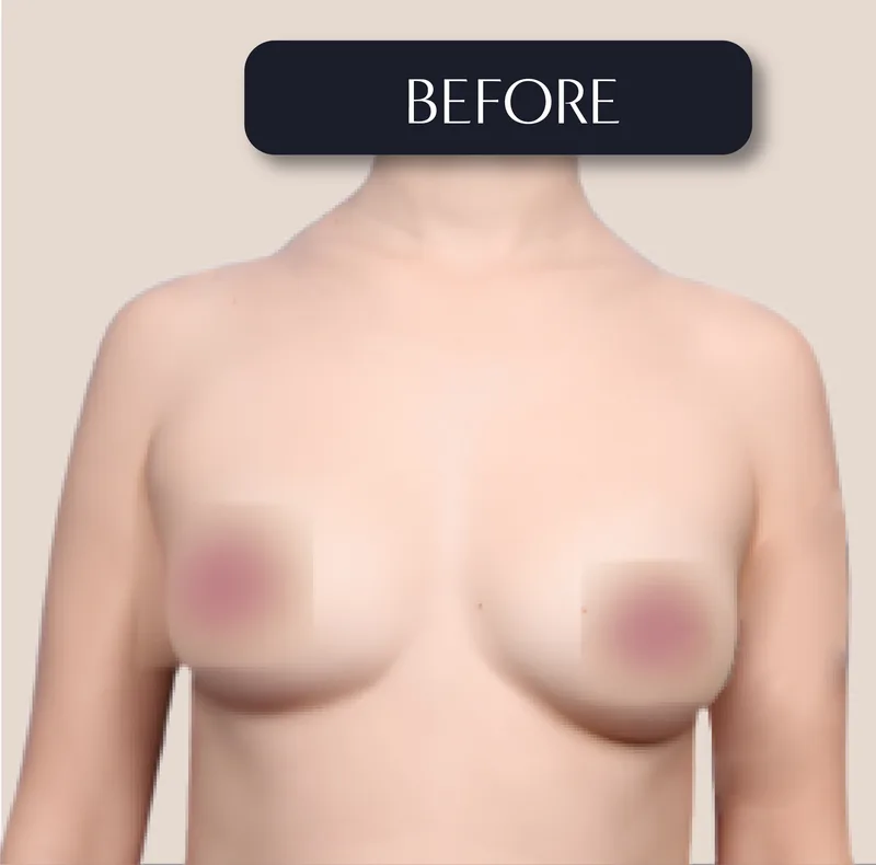 Before - Breast Augmentation - Silicone implants for natural volume and symmetry