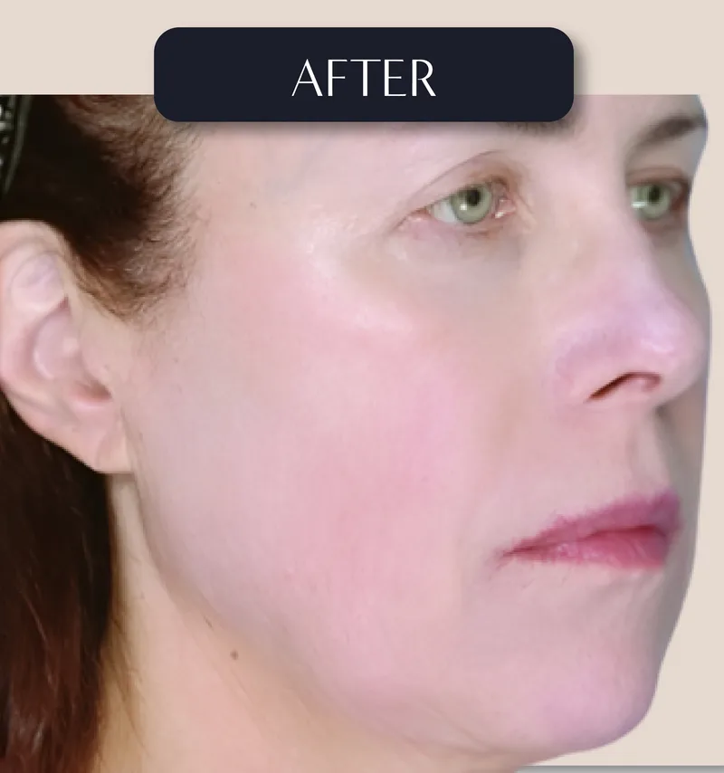After - Facelift - Facial rejuvenation with natural-looking results
