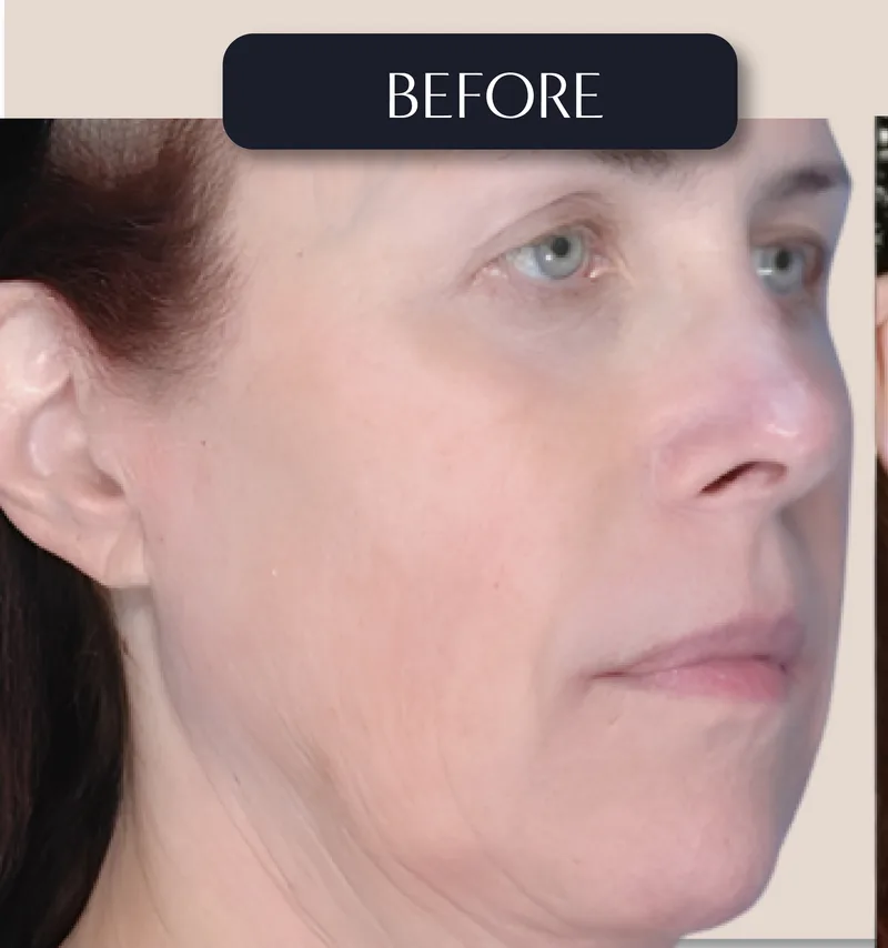 Before - Facelift - Facial rejuvenation with natural-looking results