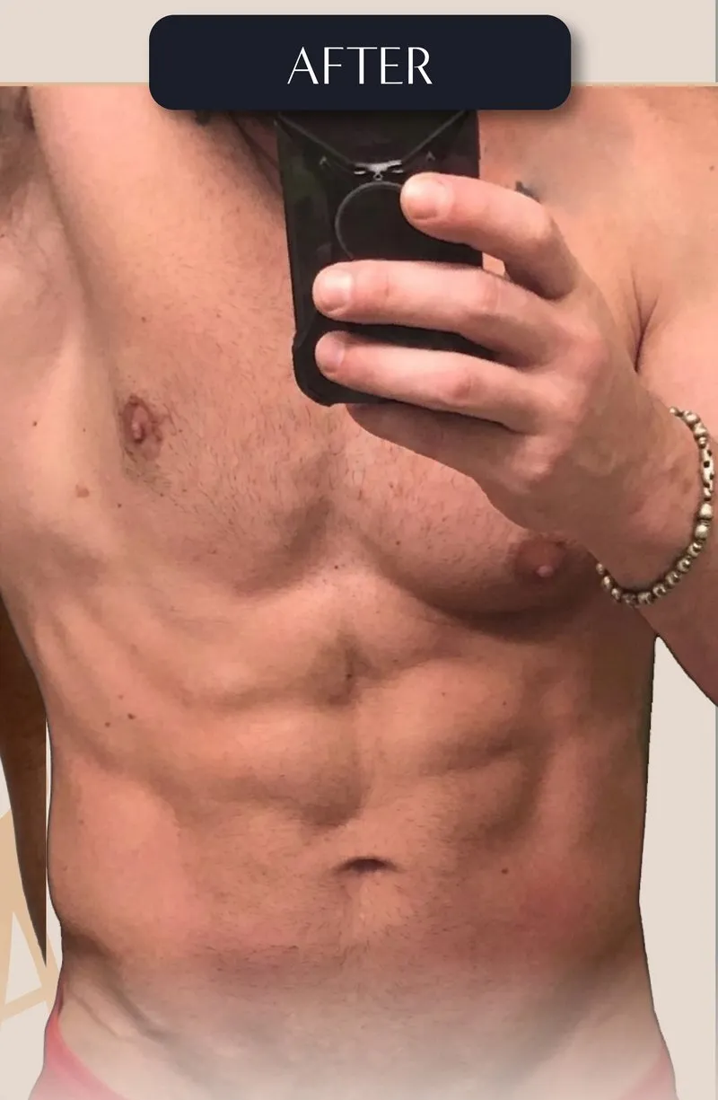 After - Liposuction before and after