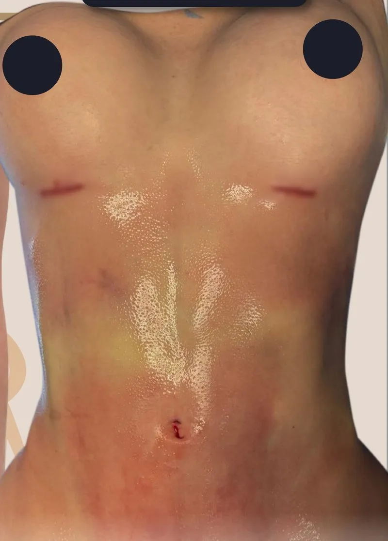 After - Liposuction before and after