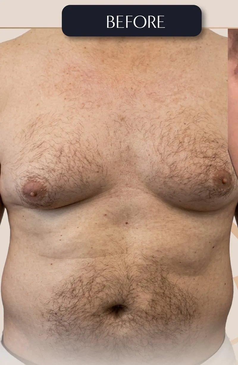 Before - Liposuction before and after