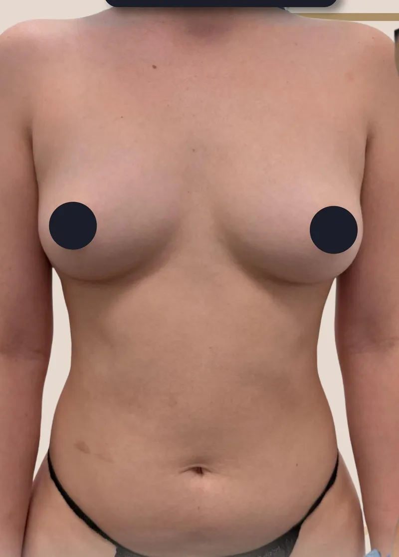 Before - Liposuction before and after