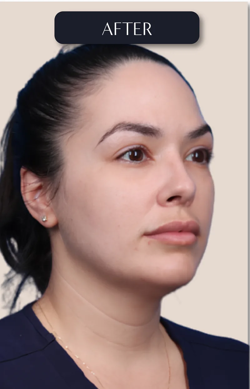 After - Rhinoplasty - Nose refinement for facial harmony