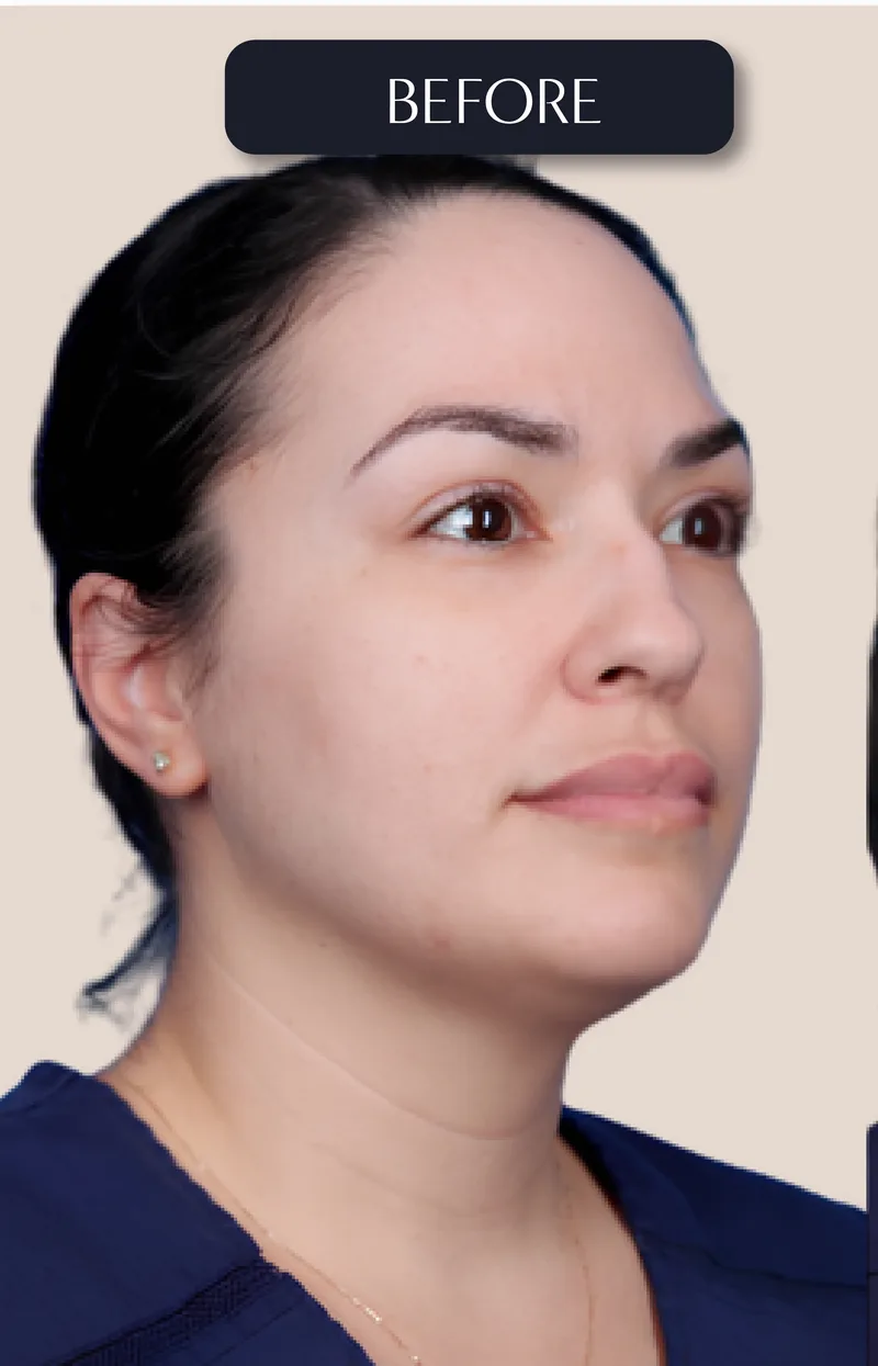 Before - Rhinoplasty - Nose refinement for facial harmony