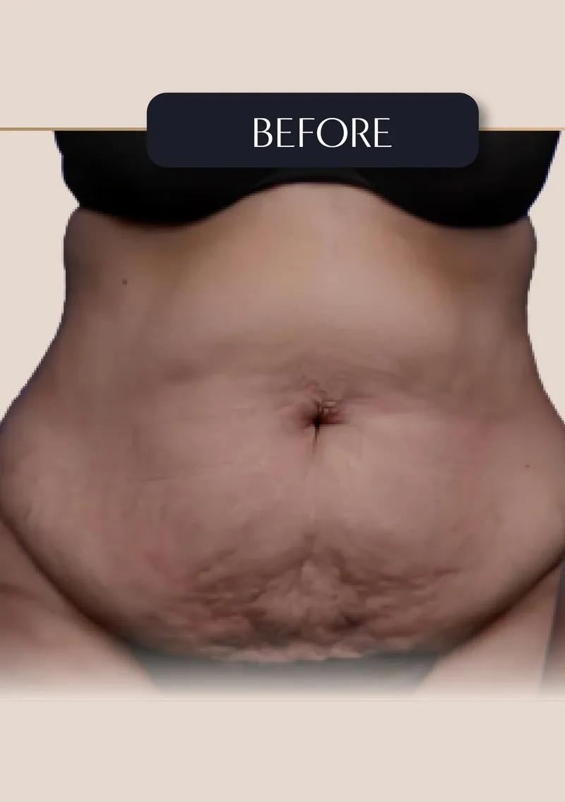 Before - Tummy Tuck - Full abdominoplasty with muscle repair