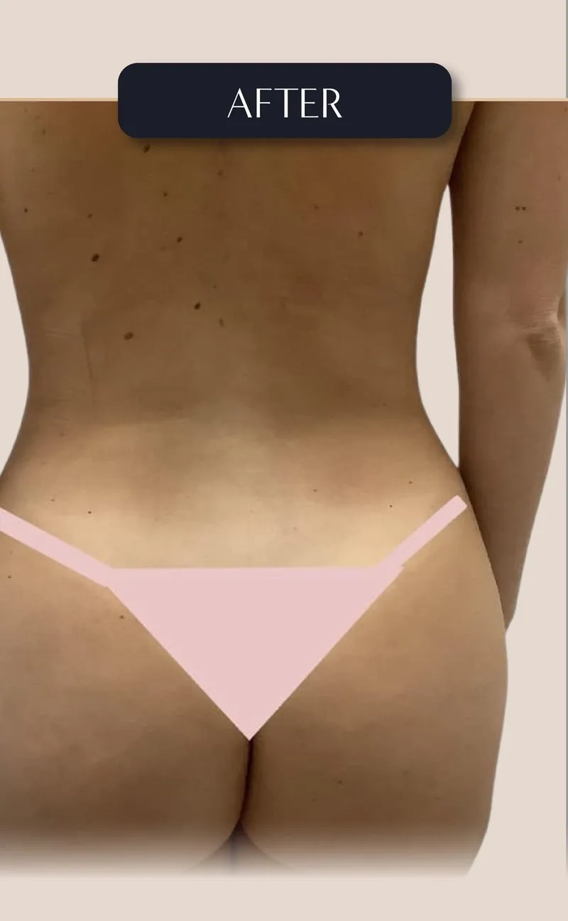 Brazilian Butt Lift (BBL)