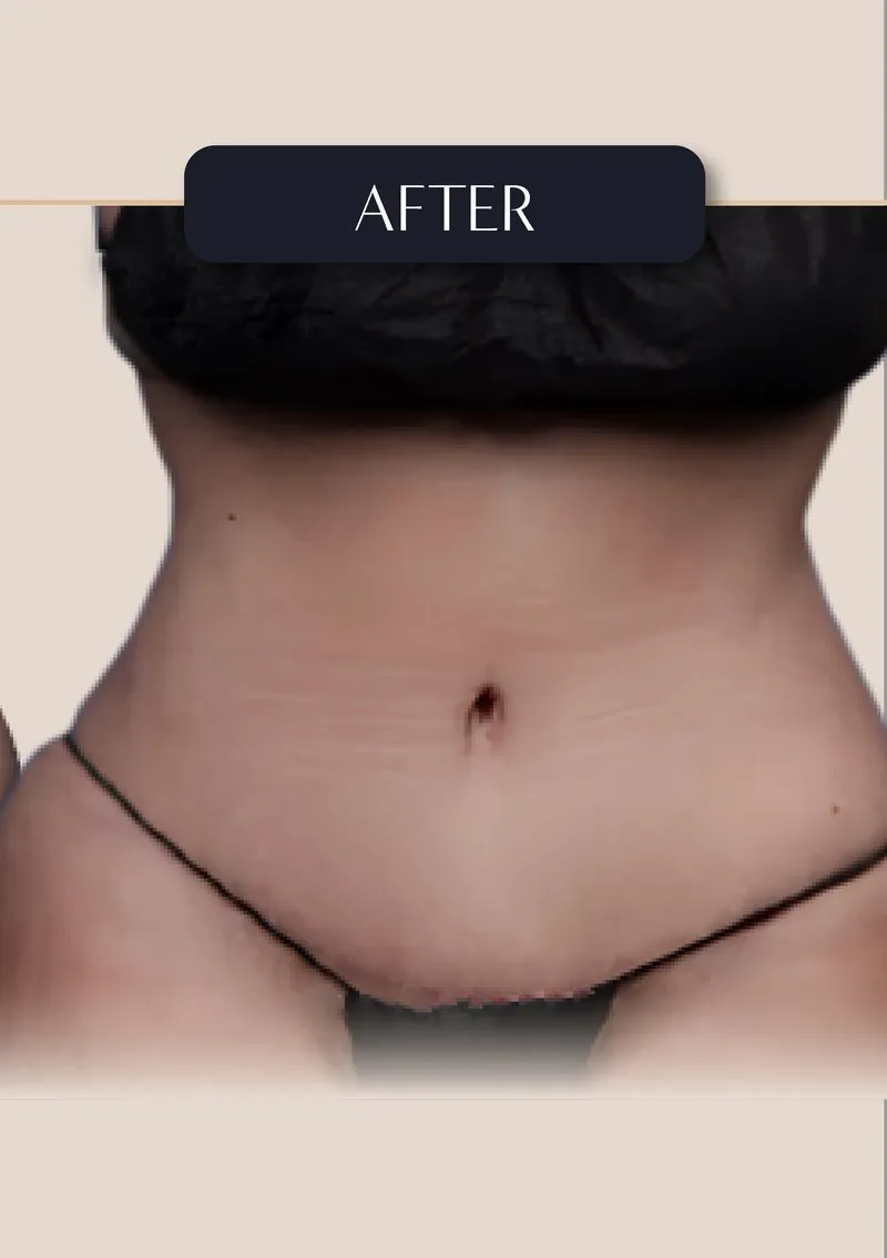 Tummy Tuck